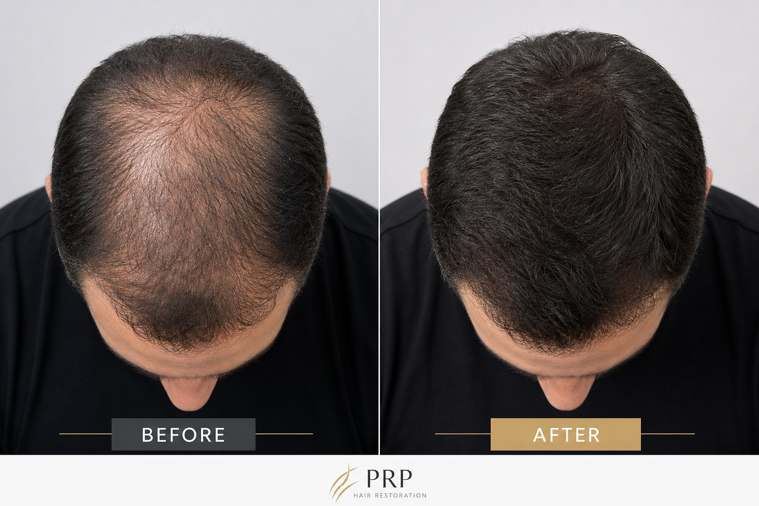 PRP for Hair Loss — Scalp Regeneration before and after