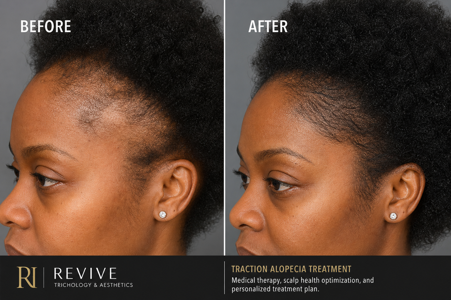 PRP for Hair Loss — Traction Alopecia before and after